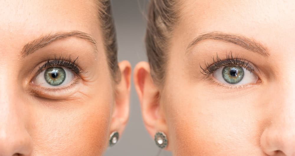 crows feet and botox treatment in houston texas