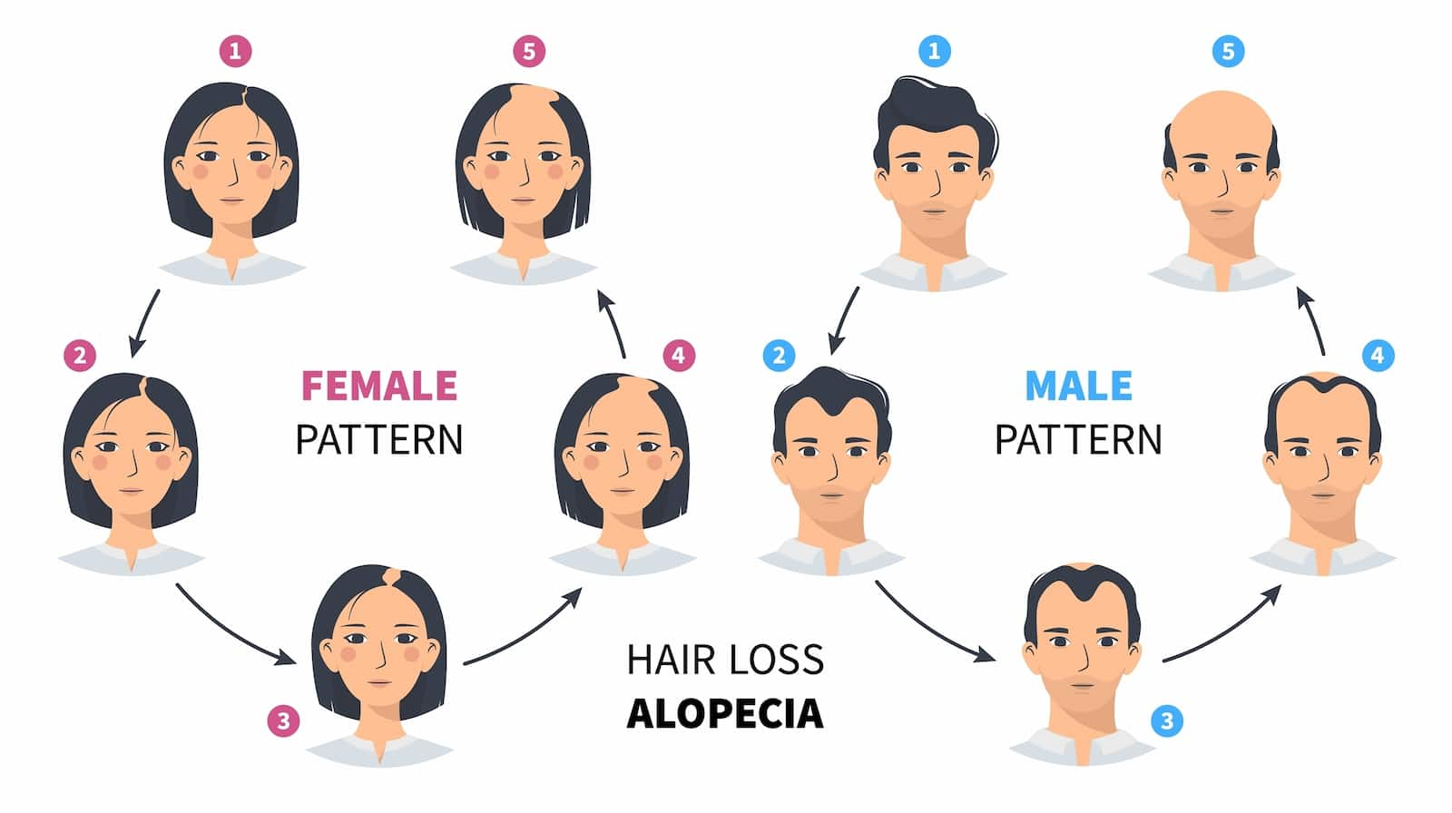 Hair Loss in Women: Types, Causes, Treatments