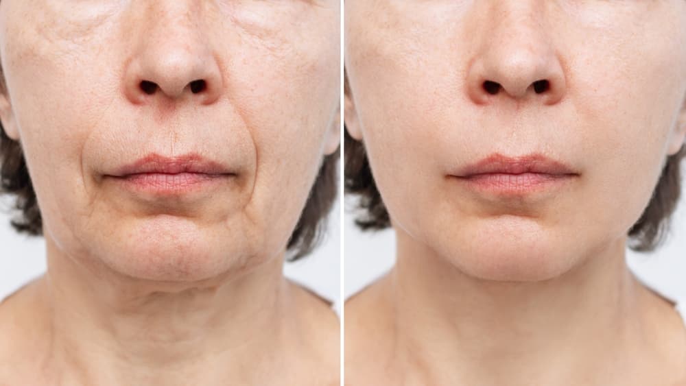 Natural Facelift Procedure: Indications, Benefits, Cost, and Recovery