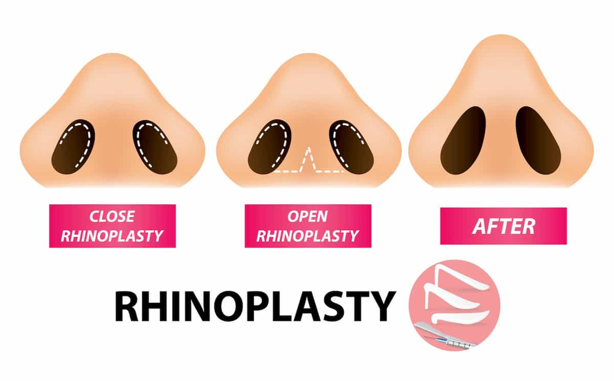 rhinoplasty in houston texas open vs closed surgical approach nose job