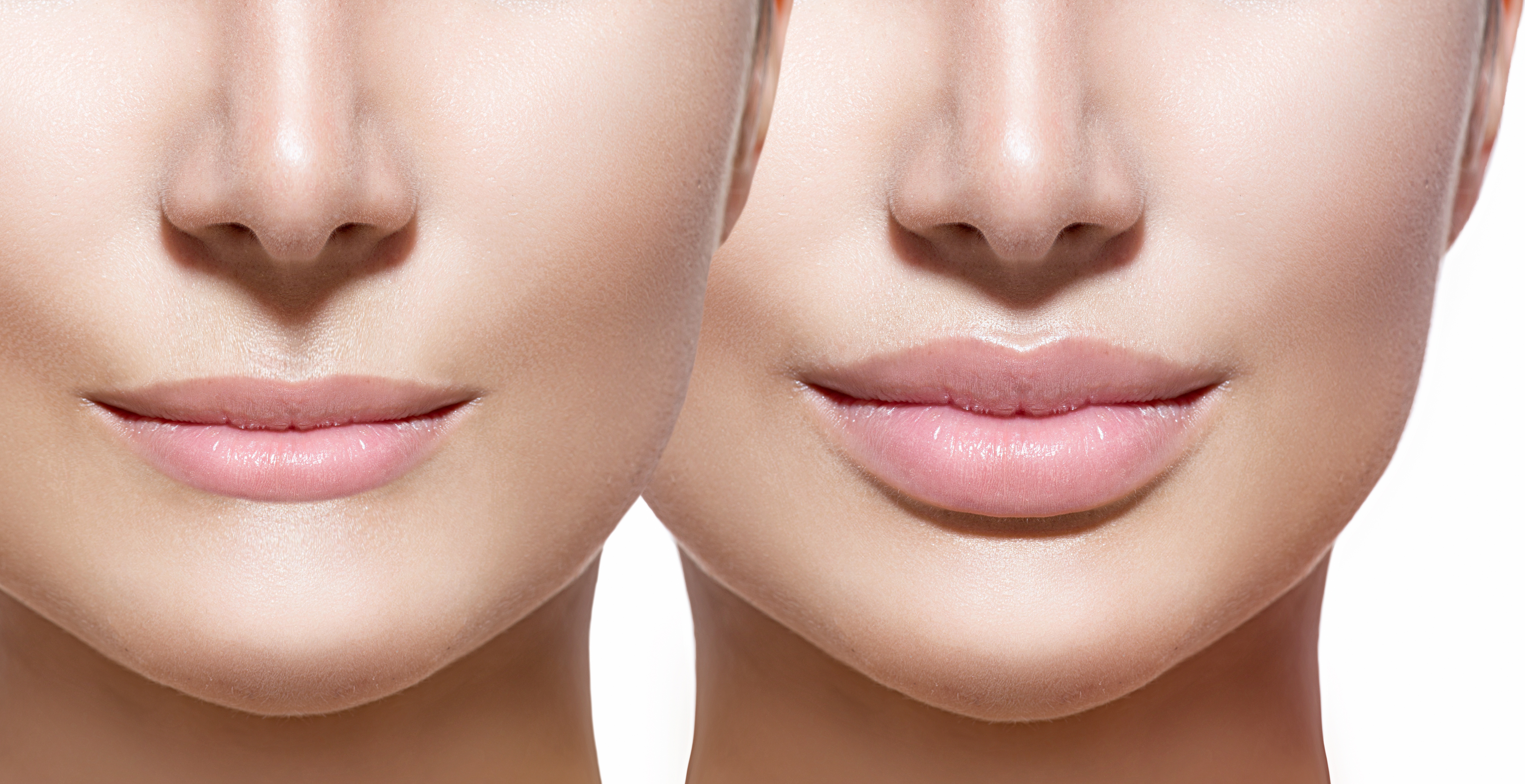 What Is a Lip Lift? Doctors Explain the Plastic Surgery Procedure That  Could Replace Lip Filler