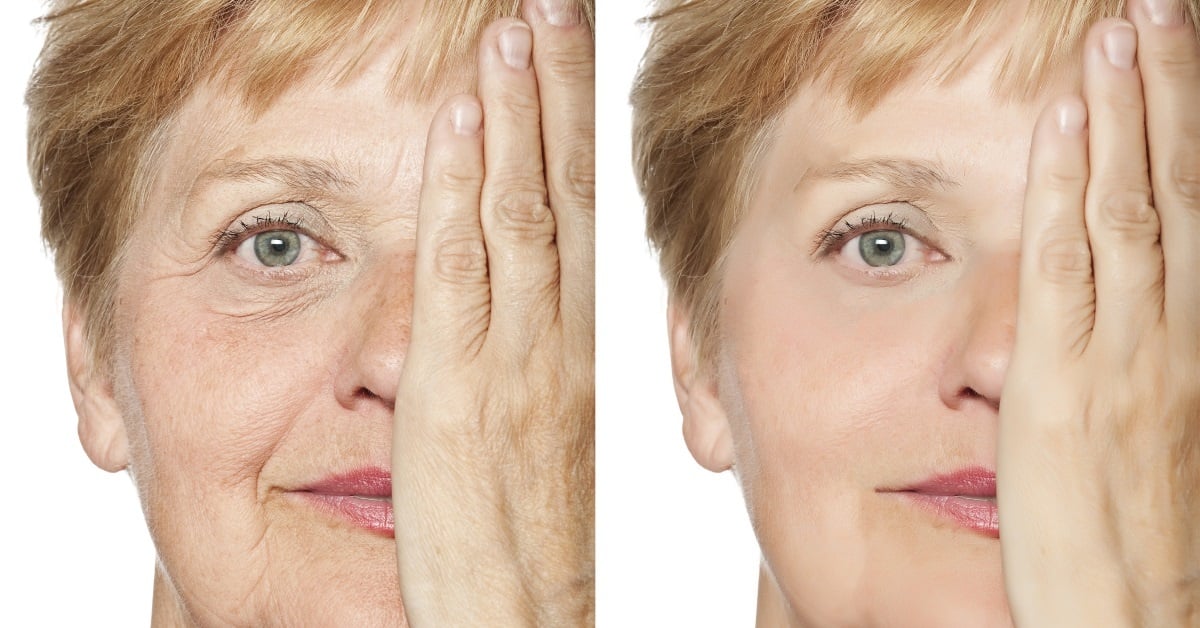 Dermal-Fillers-Before-and-After