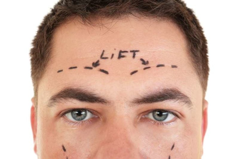 brow-lift-surgery-man-800x533