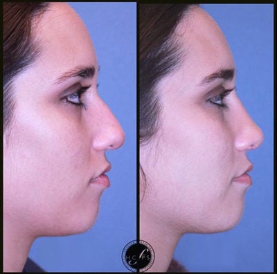 Nose Reconstruction – Rhinoplasty